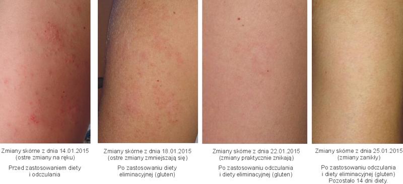 Objawy alergii na gluten u dzieci