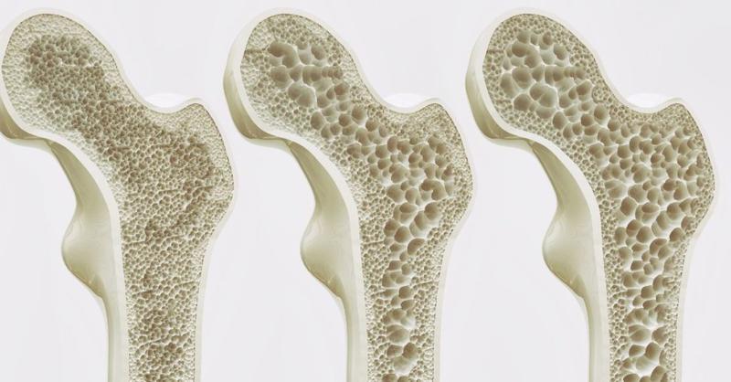 Ryzykowne ćwiczenia przy osteoporozie