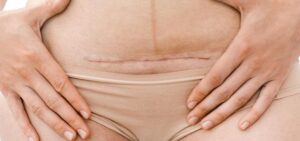 Bezpieczny powrót do ćwiczeń po cc – kluczowe porady i przeciwwskazania