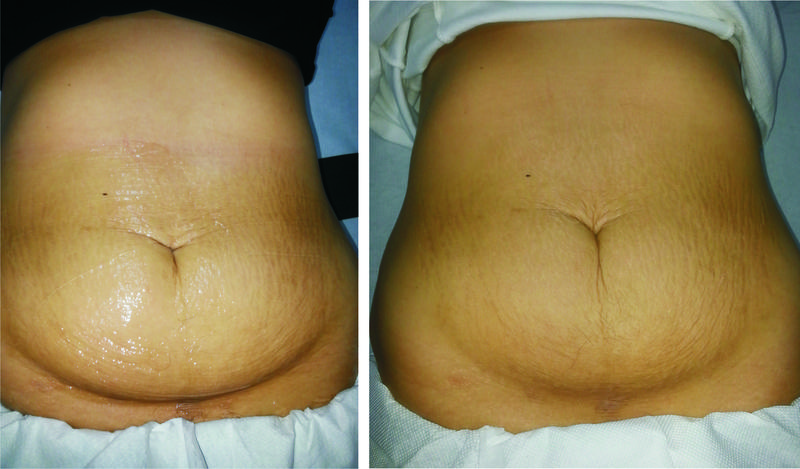 Jak monitorować postępy odchudzania