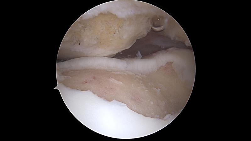 Bezpieczne ćwiczenia przy chondromalacji rzepki