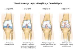Chondromalacja rzepki – które ćwiczenia mogą zaszkodzić Twoim kolanom?