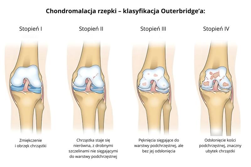 Chondromalacja rzepki – które ćwiczenia mogą zaszkodzić Twoim kolanom?